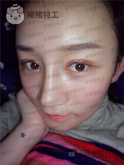 贵阳华美黄在弘面部填充案例价格分享,做这么多项目的果大家觉得好看吗?