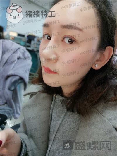 贵阳华美黄在弘面部填充案例价格分享,做这么多项目的果大家觉得好看吗?