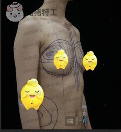 北京京韩王沛森隆胸案例价格分享,腰都变得细了我也拥有了S型曲线。