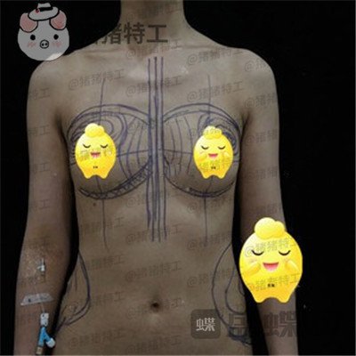 北京京韩王沛森隆胸案例价格分享,腰都变得细了我也拥有了S型曲线。