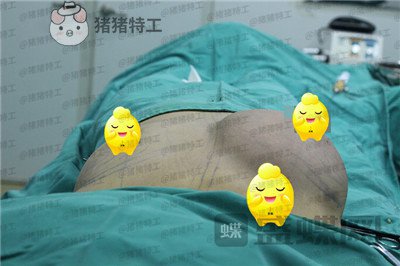 北京京韩王沛森隆胸案例价格分享,腰都变得细了我也拥有了S型曲线。
