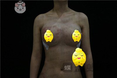北京京韩王沛森隆胸案例价格分享,腰都变得细了我也拥有了S型曲线。
