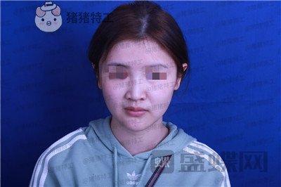 四川华人医联张淼鼻部手术案例价格分享,就做个鼻子朋友竟以为我去换头了!