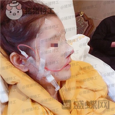 四川华人医联张淼鼻部手术案例价格分享,就做个鼻子朋友竟以为我去换头了!