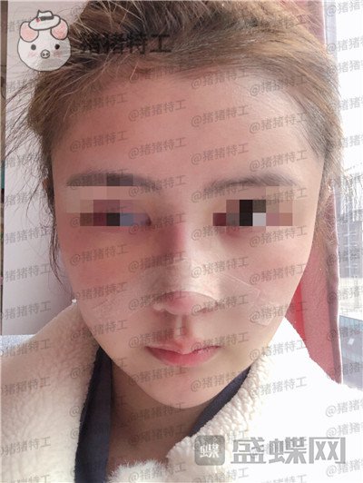 四川华人医联张淼鼻部手术案例价格分享,就做个鼻子朋友竟以为我去换头了!