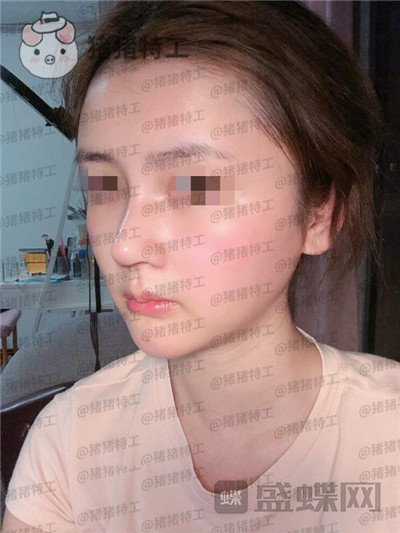 四川华人医联张淼鼻部手术案例价格分享,就做个鼻子朋友竟以为我去换头了!