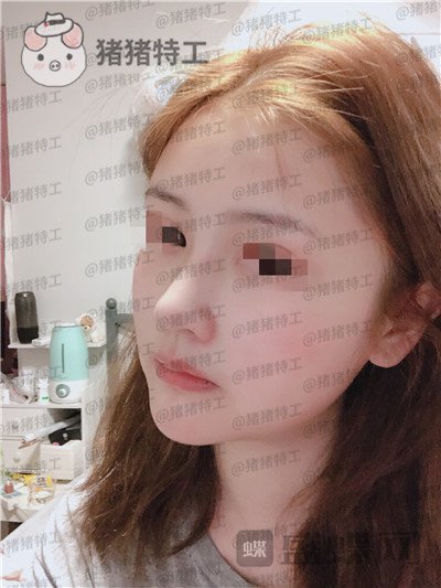 四川华人医联张淼鼻部手术案例价格分享,就做个鼻子朋友竟以为我去换头了!