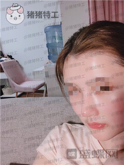 四川华人医联张淼鼻部手术案例价格分享,就做个鼻子朋友竟以为我去换头了!