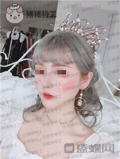四川华人医联张淼鼻部手术案例价格分享,就做个鼻子朋友竟以为我去换头了!