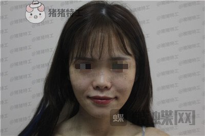 成都西区医院车红昌隆鼻案例价格分享,做完变仙女自拍前置像头都很好看~