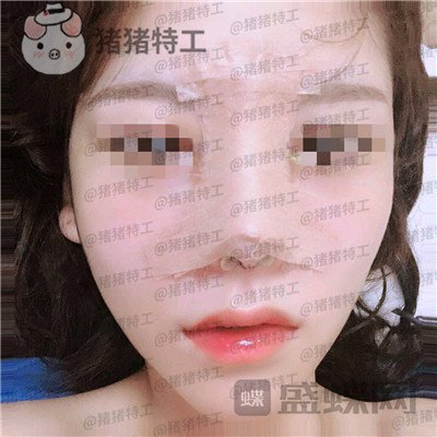 成都西区医院车红昌隆鼻案例价格分享,做完变仙女自拍前置像头都很好看~