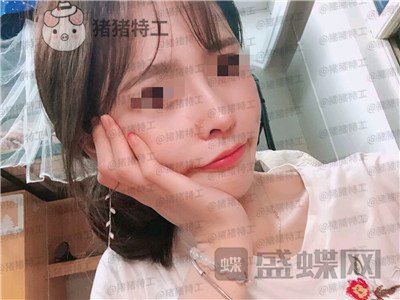 成都西区医院车红昌隆鼻案例价格分享,做完变仙女自拍前置像头都很好看~
