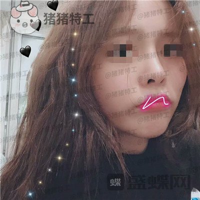 成都西区医院车红昌隆鼻案例价格分享,做完变仙女自拍前置像头都很好看~