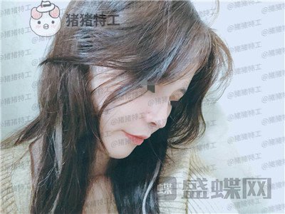 成都西区医院车红昌隆鼻案例价格分享,做完变仙女自拍前置像头都很好看~