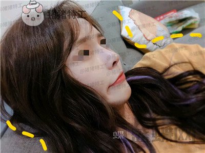 成都西区医院车红昌隆鼻案例价格分享,做完变仙女自拍前置像头都很好看~