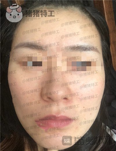 上海九院张盈帆下颌角整形案例价格分享,觉得自己现在超美的充满自信!