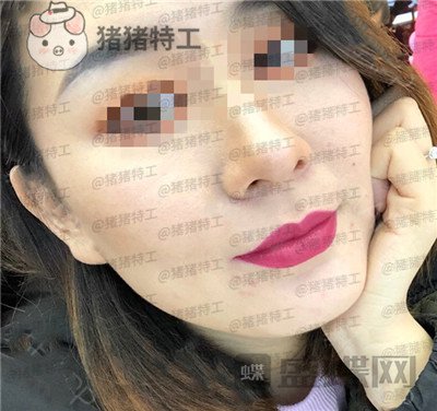 上海九院张盈帆下颌角整形案例价格分享,觉得自己现在超美的充满自信!