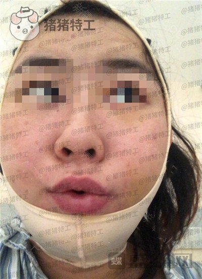 上海九院张盈帆下颌角整形案例价格分享,觉得自己现在超美的充满自信!