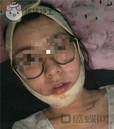上海九院张盈帆下颌角整形案例价格分享,觉得自己现在超美的充满自信!