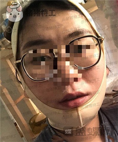 上海九院张盈帆下颌角整形案例价格分享,觉得自己现在超美的充满自信!
