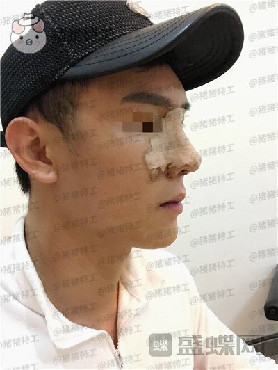 深圳艾妍徐荣阳隆鼻案例价格分享,以为是逆天换头术竟然只是做了个鼻子?