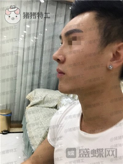 深圳艾妍徐荣阳隆鼻案例价格分享,以为是逆天换头术竟然只是做了个鼻子?