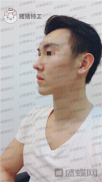 深圳艾妍徐荣阳隆鼻案例价格分享,以为是逆天换头术竟然只是做了个鼻子?