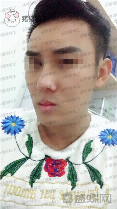 深圳艾妍徐荣阳隆鼻案例价格分享,以为是逆天换头术竟然只是做了个鼻子?