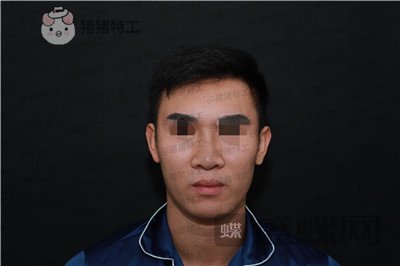 深圳艾妍徐荣阳隆鼻案例价格分享,以为是逆天换头术竟然只是做了个鼻子?