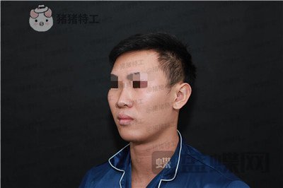 深圳艾妍徐荣阳隆鼻案例价格分享,以为是逆天换头术竟然只是做了个鼻子?