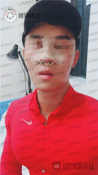 深圳艾妍徐荣阳隆鼻案例价格分享,以为是逆天换头术竟然只是做了个鼻子?
