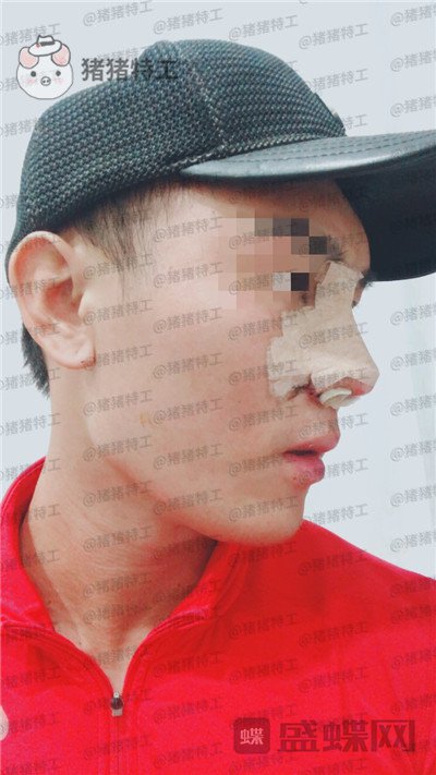 深圳艾妍徐荣阳隆鼻案例价格分享,以为是逆天换头术竟然只是做了个鼻子?