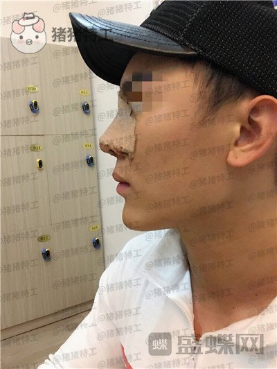 深圳艾妍徐荣阳隆鼻案例价格分享,以为是逆天换头术竟然只是做了个鼻子?