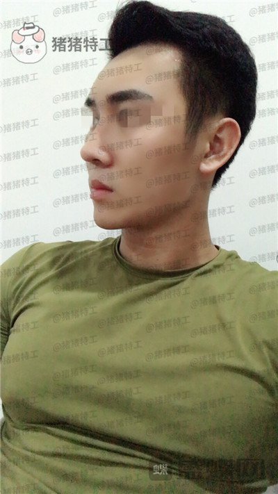 深圳艾妍徐荣阳隆鼻案例价格分享,以为是逆天换头术竟然只是做了个鼻子?