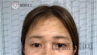 广东画美牟北平双眼皮案例价格分享,想要自然双眼皮的小仙女注意啦!