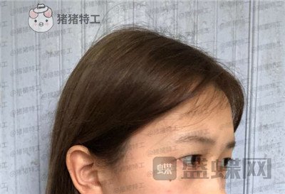 广东画美牟北平双眼皮案例价格分享,想要自然双眼皮的小仙女注意啦!