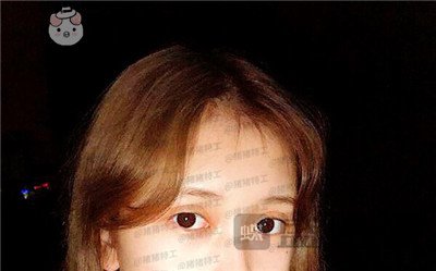 广东画美牟北平双眼皮案例价格分享,想要自然双眼皮的小仙女注意啦!