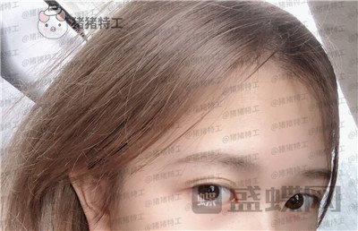 广东画美牟北平双眼皮案例价格分享,想要自然双眼皮的小仙女注意啦!