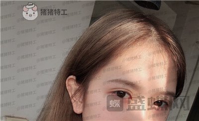广东画美牟北平双眼皮案例价格分享,想要自然双眼皮的小仙女注意啦!