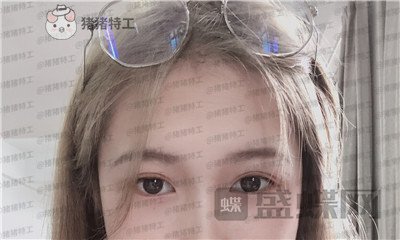 广东画美牟北平双眼皮案例价格分享,想要自然双眼皮的小仙女注意啦!