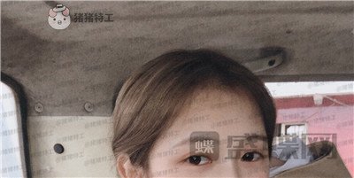 广东画美牟北平双眼皮案例价格分享,想要自然双眼皮的小仙女注意啦!