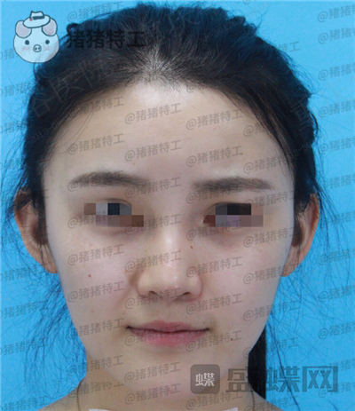 重庆华美蒋琳隆鼻案例价格分享,仙女隆鼻之后是一种是什么体验?