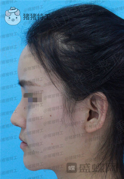 重庆华美蒋琳隆鼻案例价格分享,仙女隆鼻之后是一种是什么体验?