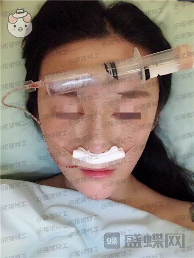 重庆华美蒋琳隆鼻案例价格分享,仙女隆鼻之后是一种是什么体验?