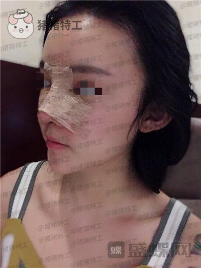重庆华美蒋琳隆鼻案例价格分享,仙女隆鼻之后是一种是什么体验?