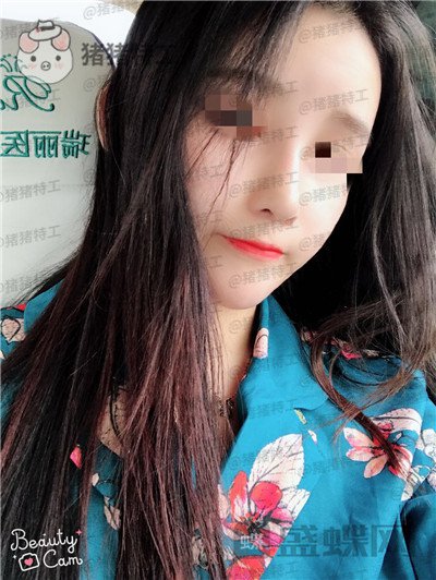 重庆华美蒋琳隆鼻案例价格分享,仙女隆鼻之后是一种是什么体验?