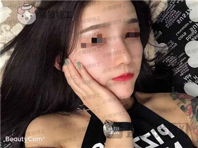重庆华美蒋琳隆鼻案例价格分享,仙女隆鼻之后是一种是什么体验?
