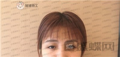 杭州艺星杨连华眼部手术案例价格分享,这个眼睛真的是可爱萌占完了!