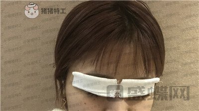 杭州艺星杨连华眼部手术案例价格分享,这个眼睛真的是可爱萌占完了!