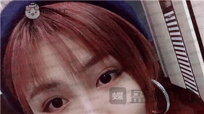 杭州艺星杨连华眼部手术案例价格分享,这个眼睛真的是可爱萌占完了!